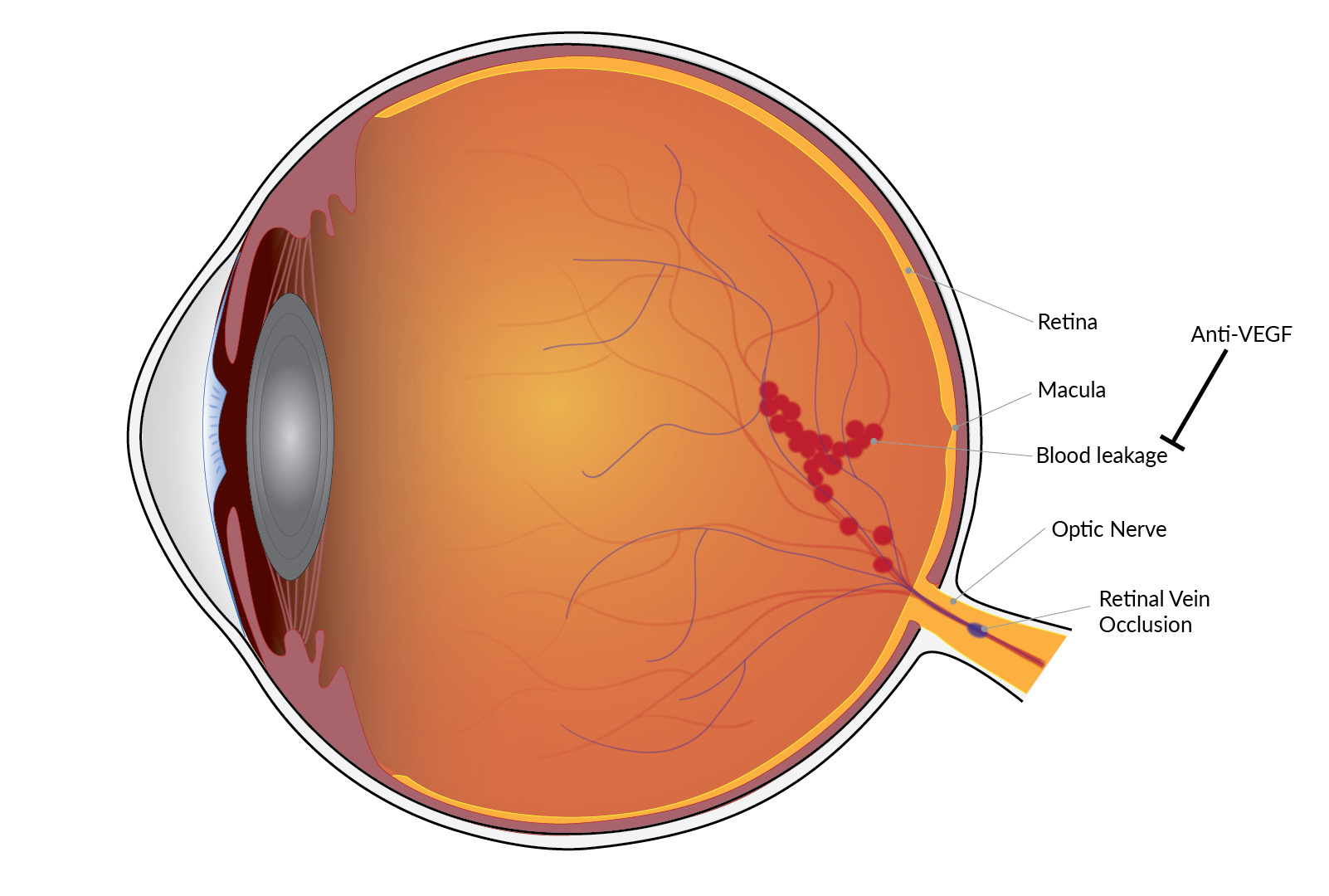 Treating Eye Vein Blockages Nih News In Health