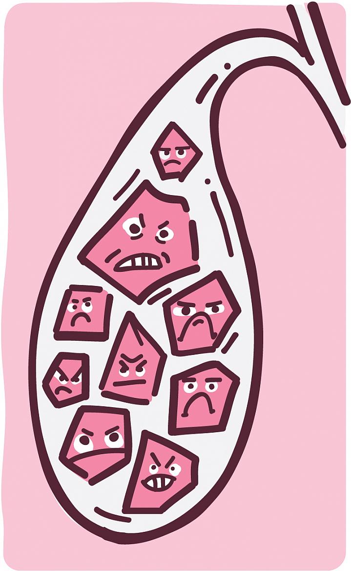 Illustration of gallstones inside a gallbladder.