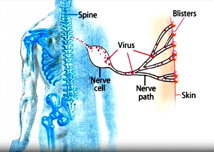 Illustration of the shingles pathway in the body